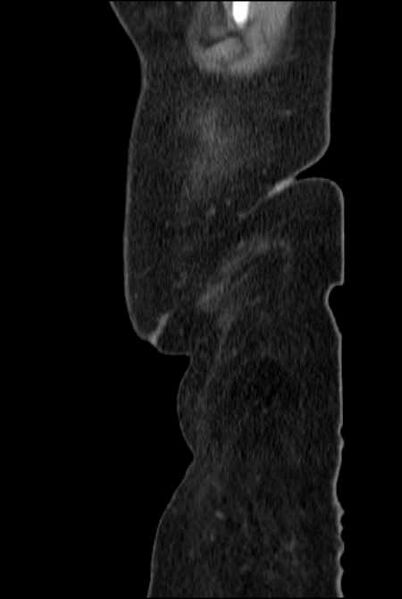 File:Brown tumors compressing the spinal cord (Radiopaedia 68442-77988 F 2).jpg