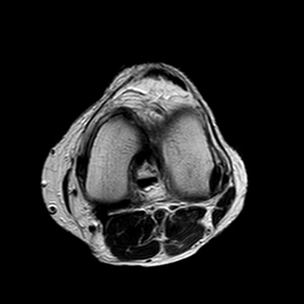 File:Bucket handle tear - medial meniscus (Radiopaedia 29250-29664 Axial T2 8).jpg