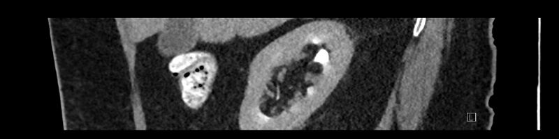 File:Buried bumper syndrome - gastrostomy tube (Radiopaedia 63843-72575 Sagittal Inject 89).jpg