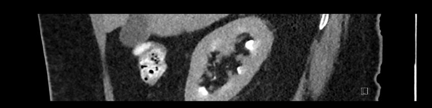 Buried bumper syndrome - gastrostomy tube (Radiopaedia 63843-72575 Sagittal Inject 90).jpg