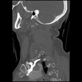 C1 anterior arch (plough) fracture - type 1 (Radiopaedia 76181-87720 Sagittal bone window 30).jpg