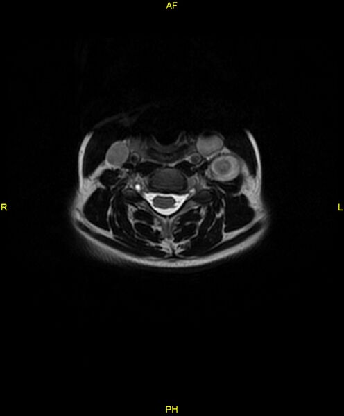 File:C5 nerve sheath tumor (Radiopaedia 85777-101596 Axial T2 36).jpg