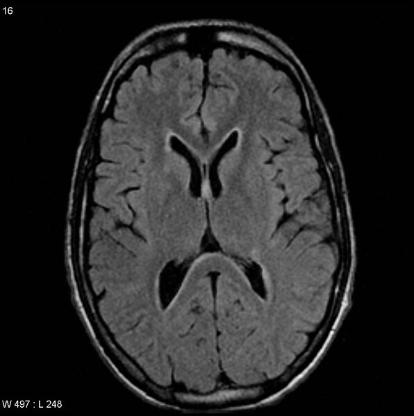 File:CMV ventriculitis and encephalitis (Radiopaedia 5416-7166 Axial FLAIR 4).jpg
