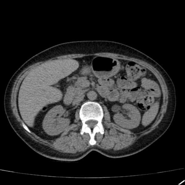 File:Calcified hepatic hydatid cyst (Radiopaedia 26872-27046 Axial non-contrast 35).jpg