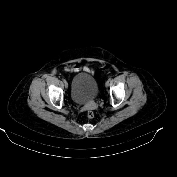 File:Calcified hydatid cyst (Radiopaedia 62000-70085 Axial non-contrast 97).jpg