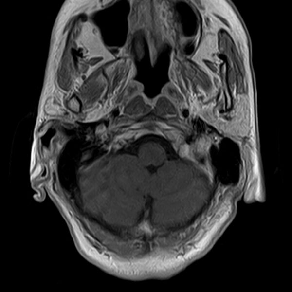 File:Calcified meningioma - cervical canal (Radiopaedia 70136-82468 Axial T1 C+ 4).jpg