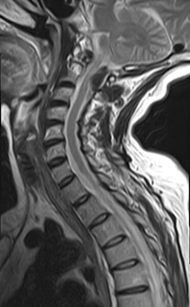 File:Calcified meningioma - cervical canal (Radiopaedia 70136-82468 Sagittal T2 9).jpg