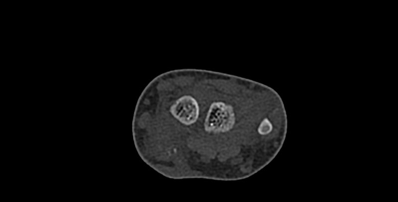 File:Calcifying aponeurotic fibroma (Radiopaedia 88423-105064 Axial bone window 47).jpg