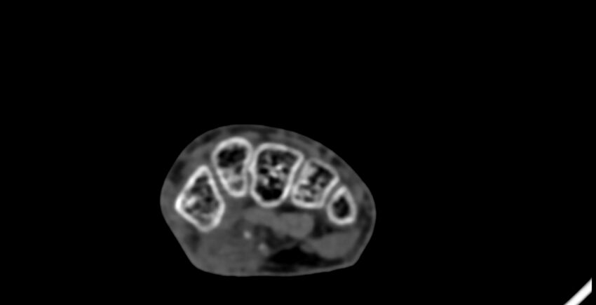 Calcifying aponeurotic fibroma (Radiopaedia 88423-105064 B 91).jpg
