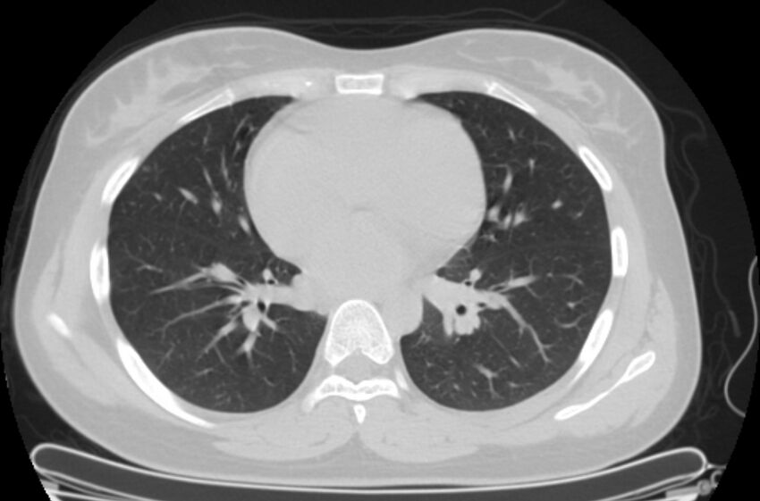 Cannonball metastases - uterine choriocarcinoma (Radiopaedia 70137-80173 Axial lung window 60).jpg