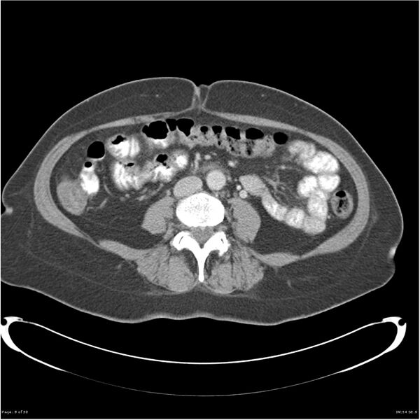 File:Carcinoid tumor of the ileum with metastasis to orbit (Radiopaedia 28165-28425 A 8).jpg