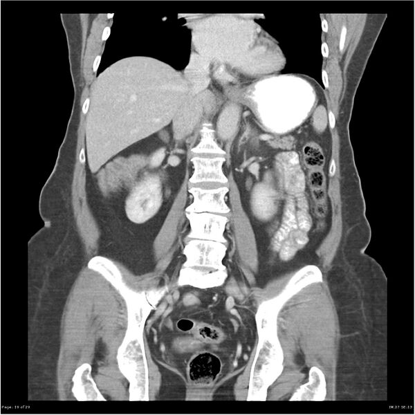File:Carcinoid tumor of the ileum with metastasis to orbit (Radiopaedia 28165-28425 B 19).jpg