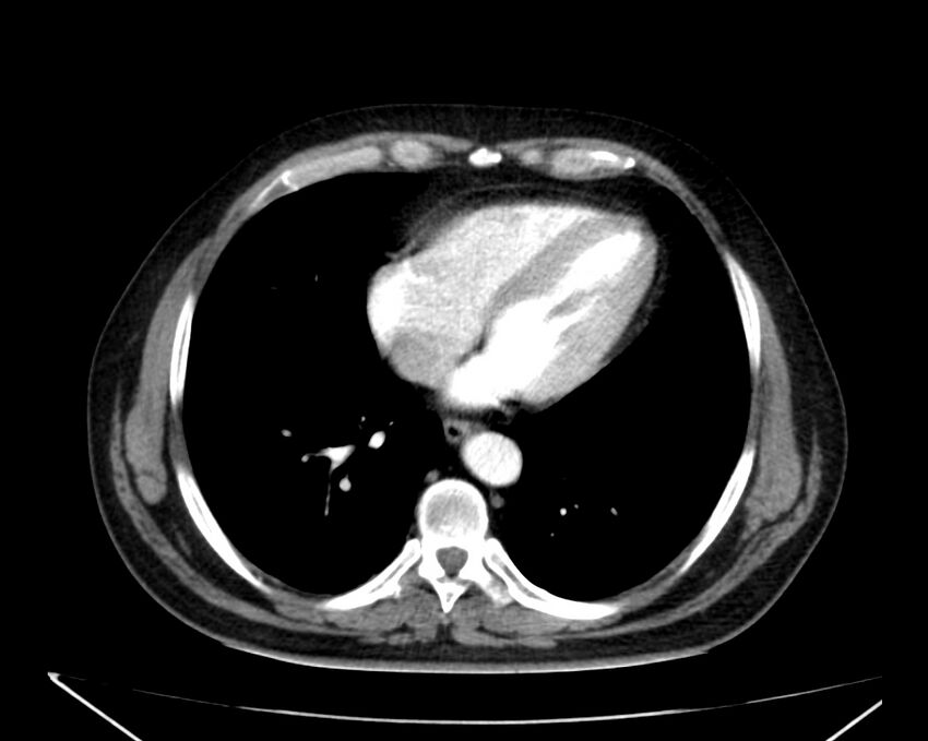 Carcinoid tumor with hepatic metastases (Radiopaedia 22651-22670 B 3).jpg