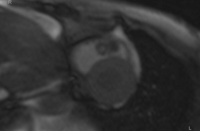 File:Cardiac hemangioma (Radiopaedia 31709-32631 Short axis 77).jpg