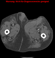 Cardiac perforation following transcatheter aortic valve implantation (Radiopaedia 23714-23863 B 25).png