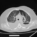 Cardiogenic pulmonary edema (Radiopaedia 29213-29609 Axial lung window 29).jpg