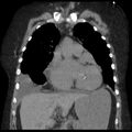 Cardiogenic pulmonary edema (Radiopaedia 29213-29609 Coronal non-contrast 15).jpg