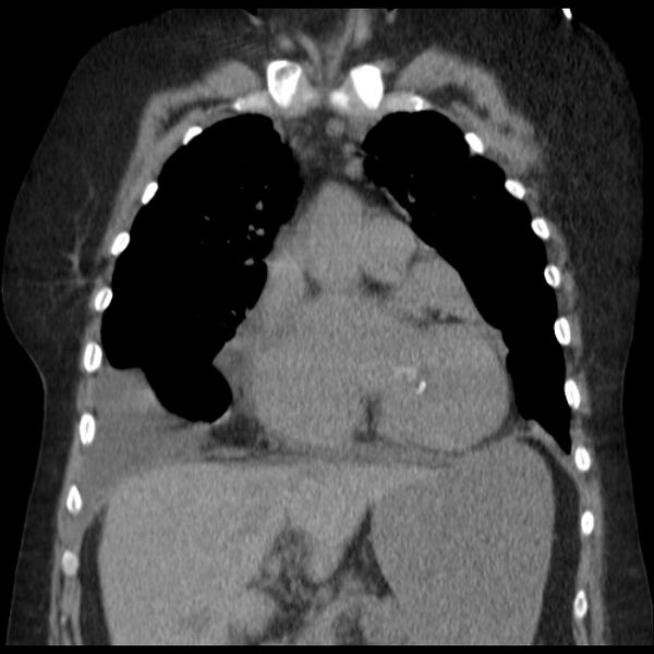 File:Cardiogenic pulmonary edema (Radiopaedia 29213-29609 Coronal non-contrast 15).jpg
