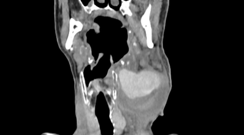 File:Carotid artery pseudoaneurysm (Radiopaedia 84030-99259 D 34).jpg
