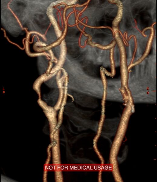 File:Carotid artery stenosis (Radiopaedia 28786-29086 A 9).jpg