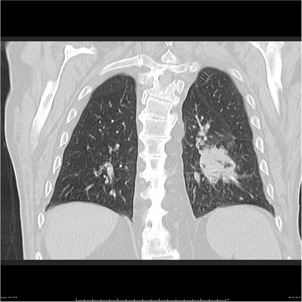 File:Cavitating left lower lobe lesion - squamous cell lung cancer (Radiopaedia 27749-28176 Coronal lung window 40).jpg