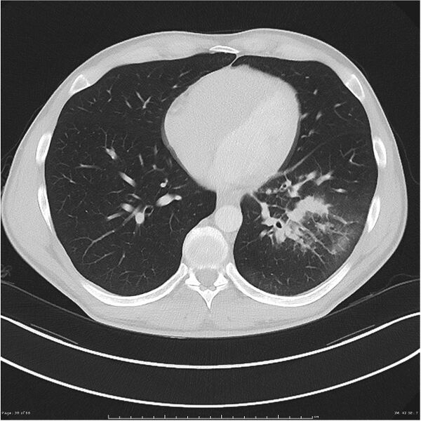 File:Cavitating lung cancer (Radiopaedia 25796-25945 Axial lung window 38).jpg
