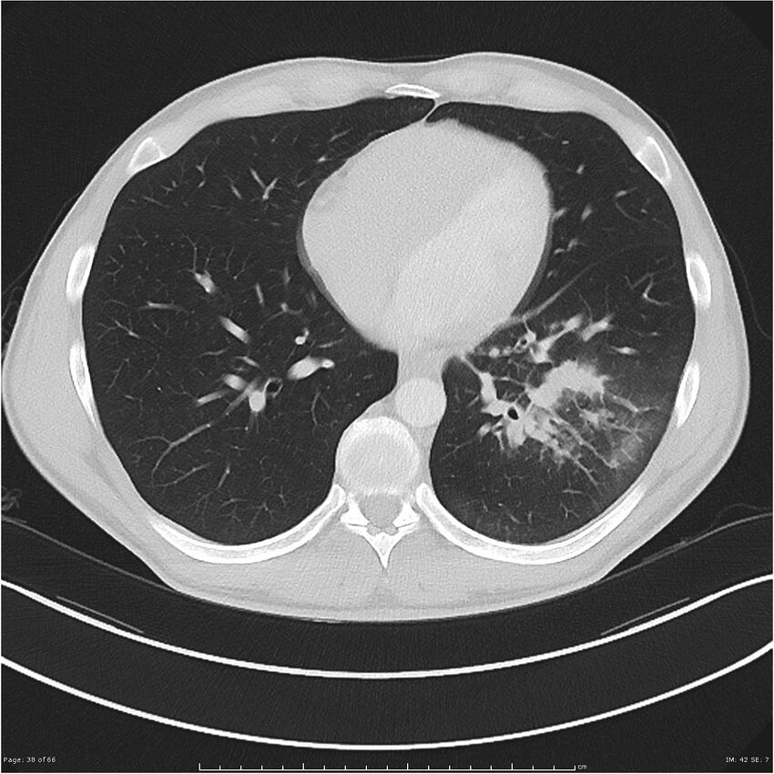 Cavitating lung cancer (Radiopaedia 25796-25945 Axial lung window 38).jpg