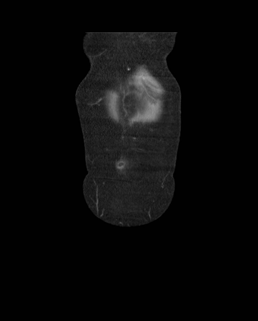 Cecal volvulus (Radiopaedia 54998-61310 B 7).jpg