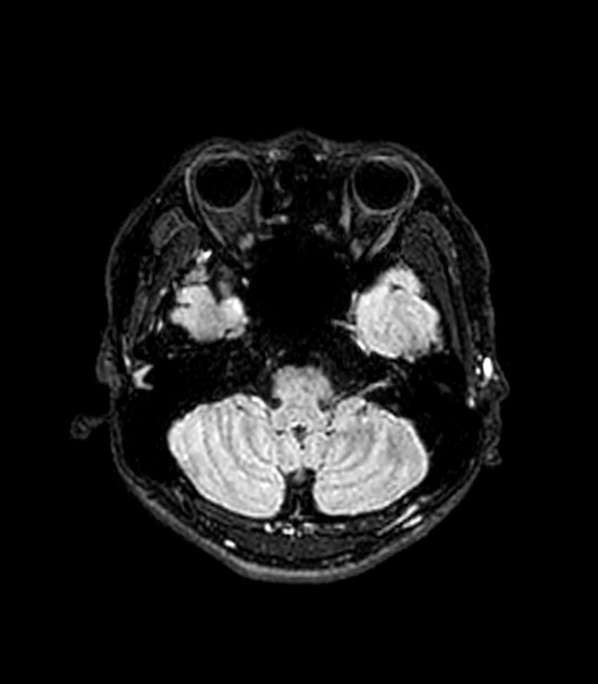 Central neurocytoma (Radiopaedia 79320-92380 Axial FLAIR 236).jpg