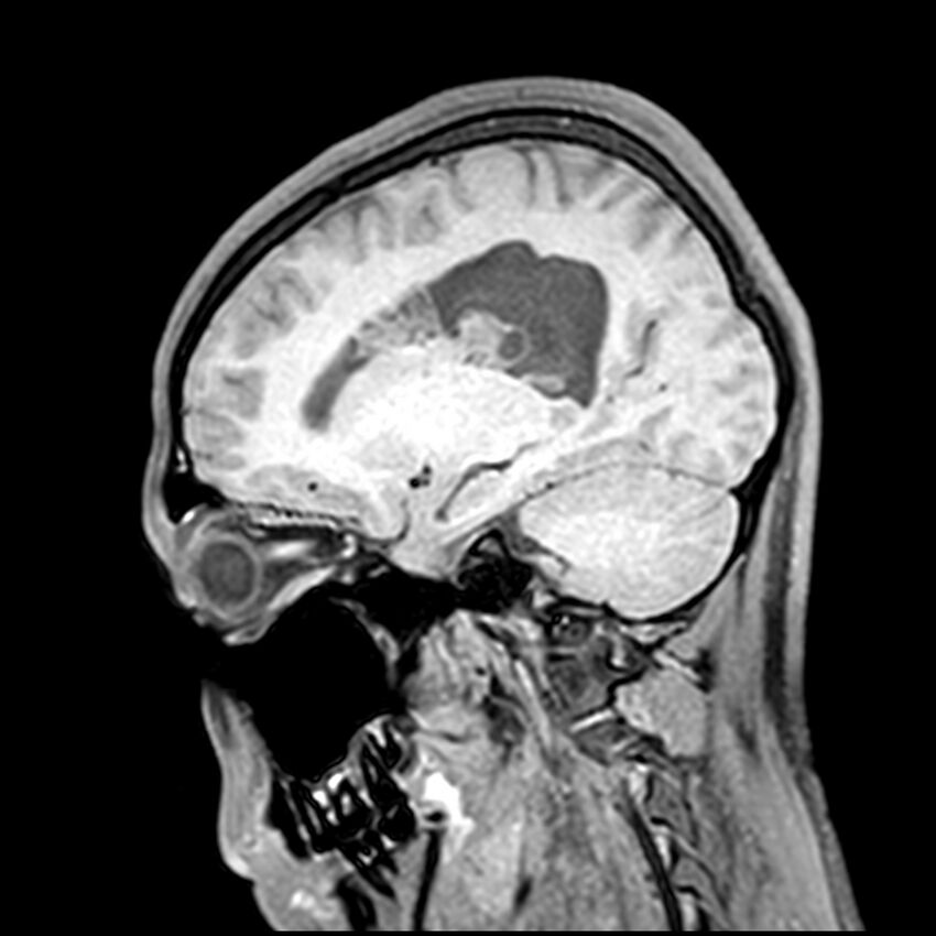 Central neurocytoma (Radiopaedia 79320-92380 Sagittal T1 168).jpg