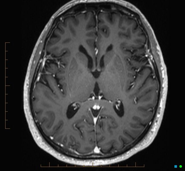 File:Cerebellar gangliocytoma (Radiopaedia 65377-74422 Axial T1 C+ 67).jpg