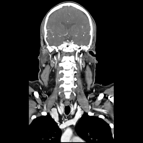 File:Cerebellar infarct due to vertebral artery dissection with posterior fossa decompression (Radiopaedia 82779-97029 D 29).png