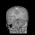 Cerebral abscess post cardiac surgery (Radiopaedia 27244-27420 Coronal T1 C+ 15).jpg