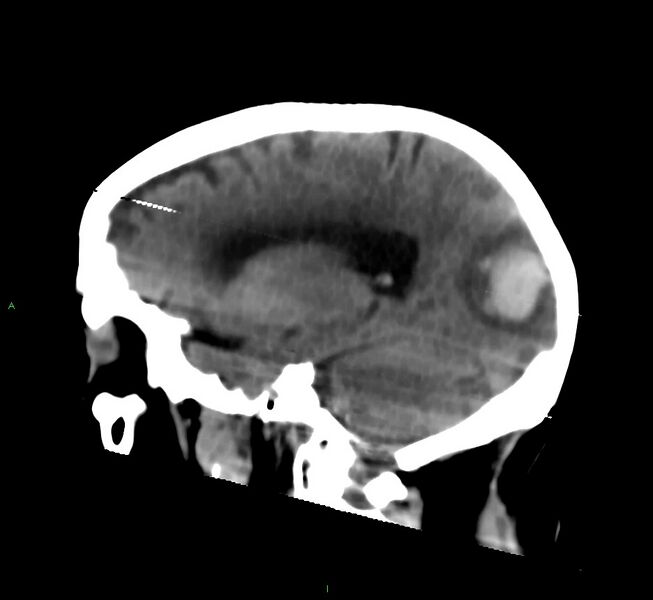 File:Cerebral amyloid angiopathy-associated lobar intracerebral hemorrhage (Radiopaedia 58377-65514 B 19).jpg