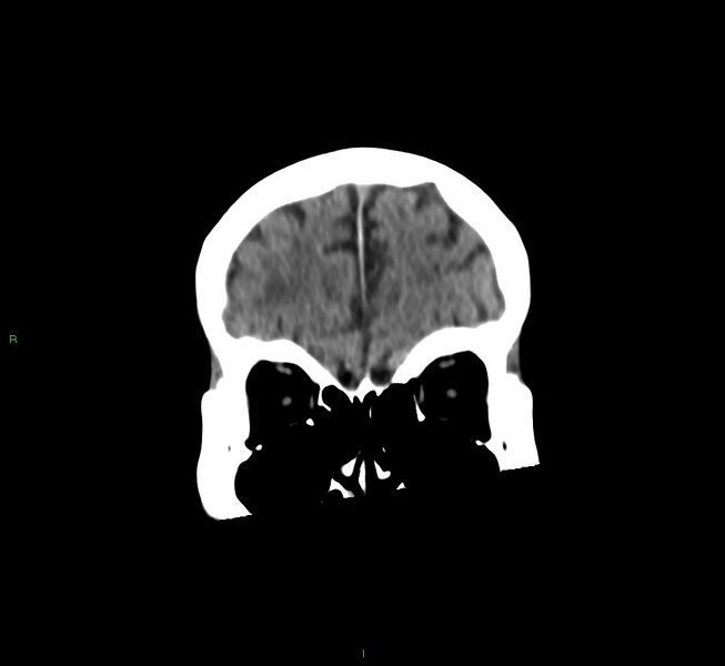 File:Cerebral amyloid angiopathy-associated lobar intracerebral hemorrhage (Radiopaedia 58530-65688 Coronal non-contrast 54).jpg