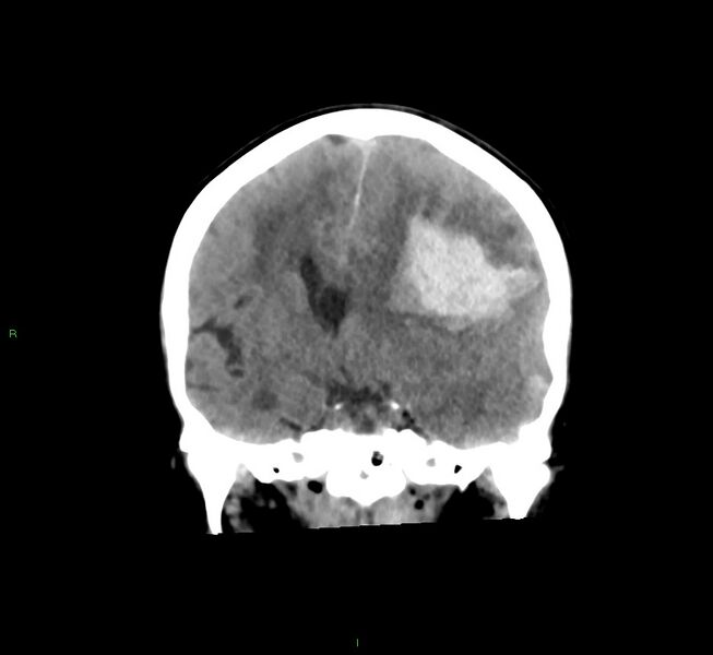 File:Cerebral amyloid angiopathy-associated lobar intracerebral hemorrhage (Radiopaedia 58561-65724 Coronal non-contrast 35).jpg