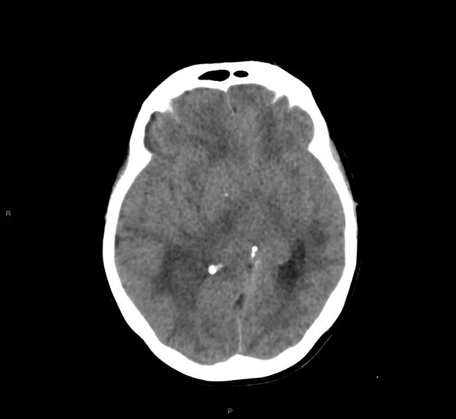 File:Cerebral amyloid angiopathy-associated lobar intracerebral hemorrhage (Radiopaedia 58751-65972 Axial non-contrast 29).jpg