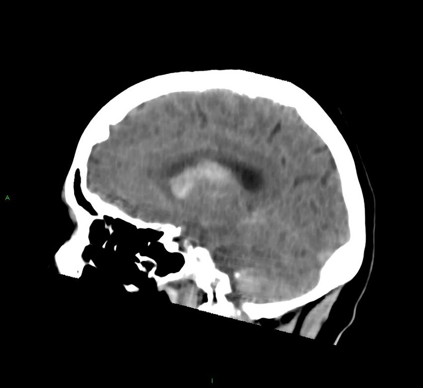 Cerebral amyloid angiopathy-associated lobar intracerebral hemorrhage (Radiopaedia 58752-65973 C 24).jpg