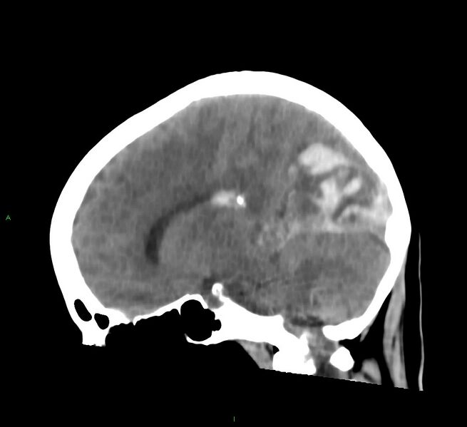 File:Cerebral amyloid angiopathy-associated lobar intracerebral hemorrhage (Radiopaedia 58754-65975 C 27).jpg