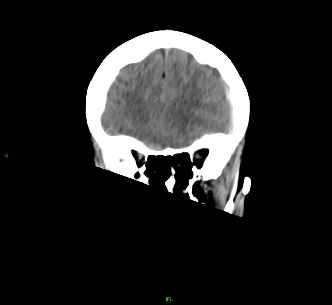 File:Cerebral amyloid angiopathy-associated lobar intracerebral hemorrhage (Radiopaedia 58754-65975 Coronal non-contrast 46).jpg
