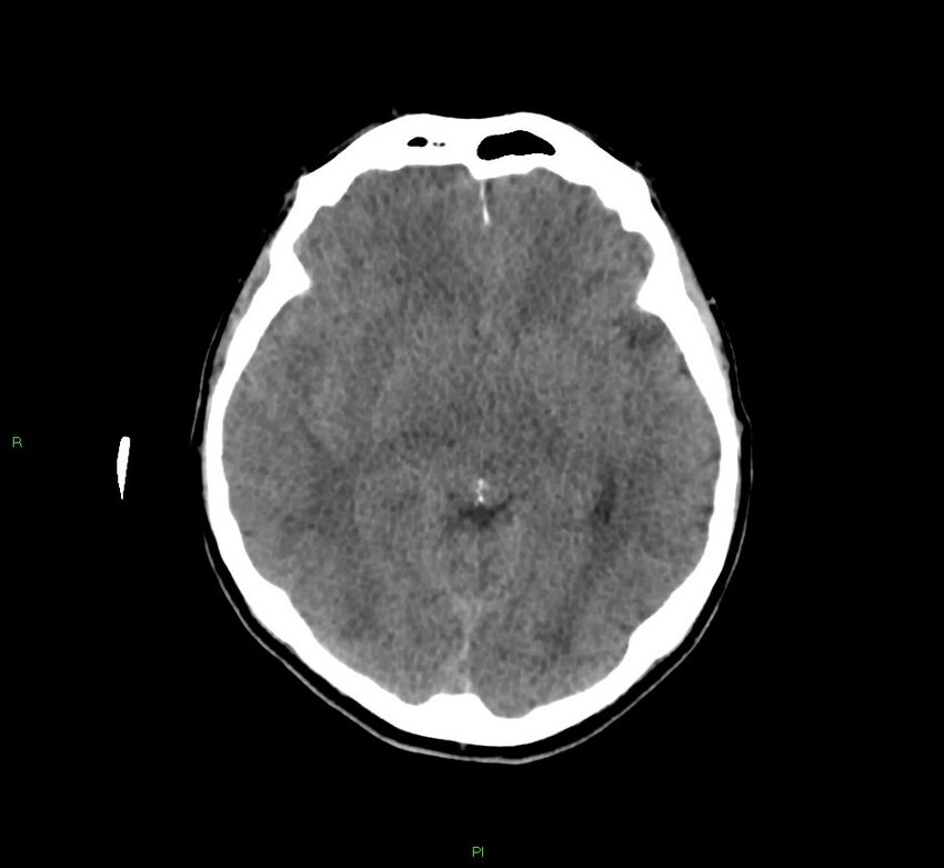 Cerebral amyloid angiopathy-associated lobar intracerebral hemorrhage (Radiopaedia 58756-65977 Axial non-contrast 31).jpg
