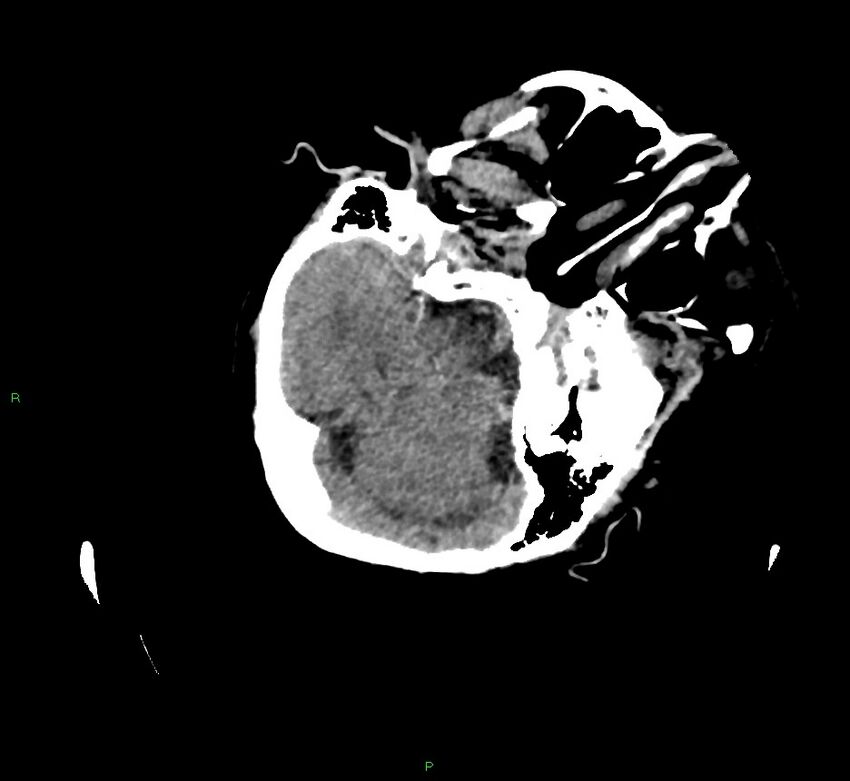 Cerebral amyloid angiopathy-associated lobar intracerebral hemorrhage (Radiopaedia 58757-65979 Axial non-contrast 39).jpg