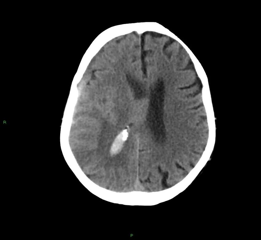 Cerebral amyloid angiopathy-associated lobar intracerebral hemorrhage (Radiopaedia 58758-65980 Axial non-contrast 19).jpg
