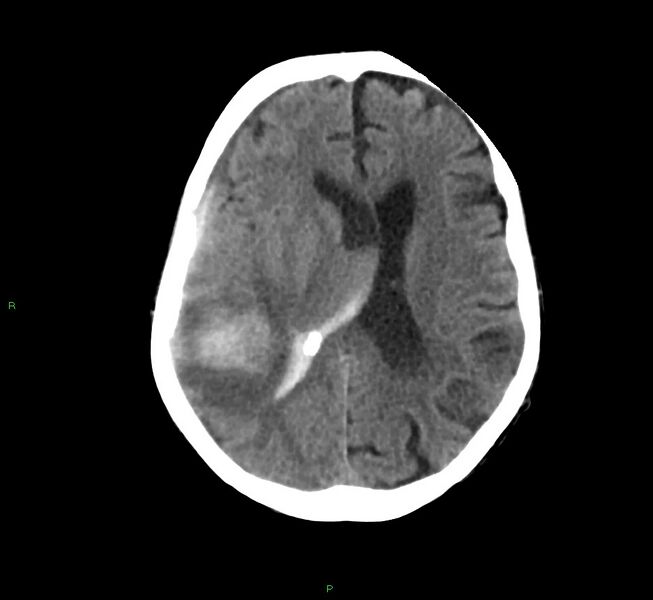 File:Cerebral amyloid angiopathy-associated lobar intracerebral hemorrhage (Radiopaedia 58758-65980 Axial non-contrast 21).jpg