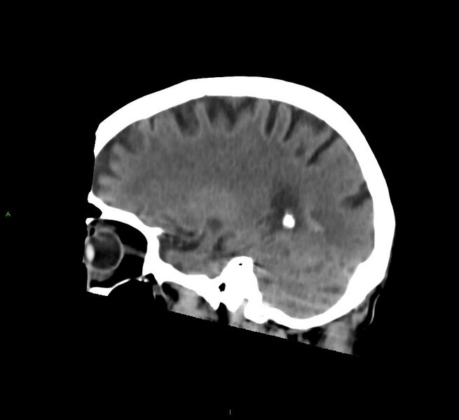 File:Cerebral amyloid angiopathy-associated lobar intracerebral hemorrhage (Radiopaedia 58758-65980 C 38).jpg