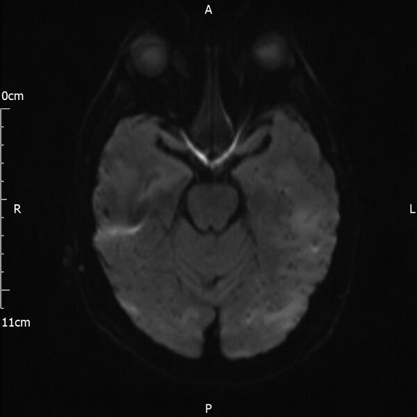 File:Cerebral amyloid angiopathy related inflammation (Radiopaedia 72772-83415 Axial DWI 32).jpg