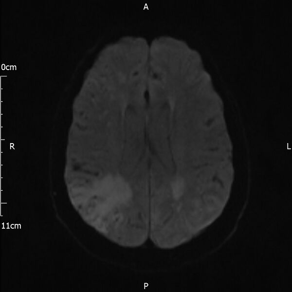 File:Cerebral amyloid angiopathy related inflammation (Radiopaedia 72772-83415 Axial DWI 38).jpg
