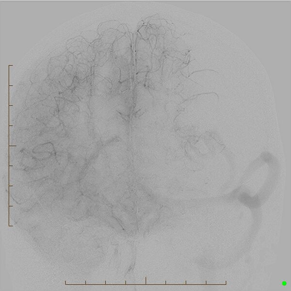 File:Cerebral arteriovenous malformation (AVM) (Radiopaedia 78162-90707 A 14).jpg