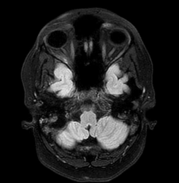 File:Cerebral arteriovenous malformation (Radiopaedia 74411-90758 Axial FLAIR 6).jpg