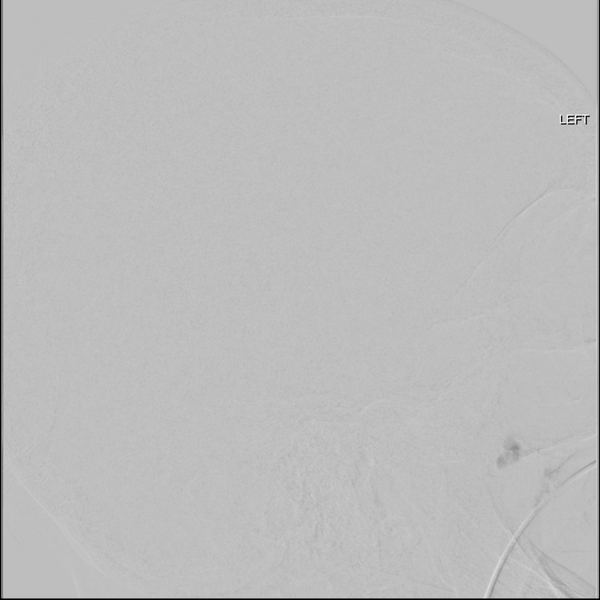 File:Cerebral arteriovenous malformation with lobar hemorrhage (Radiopaedia 44725-48513 LT CCA IC 27).png